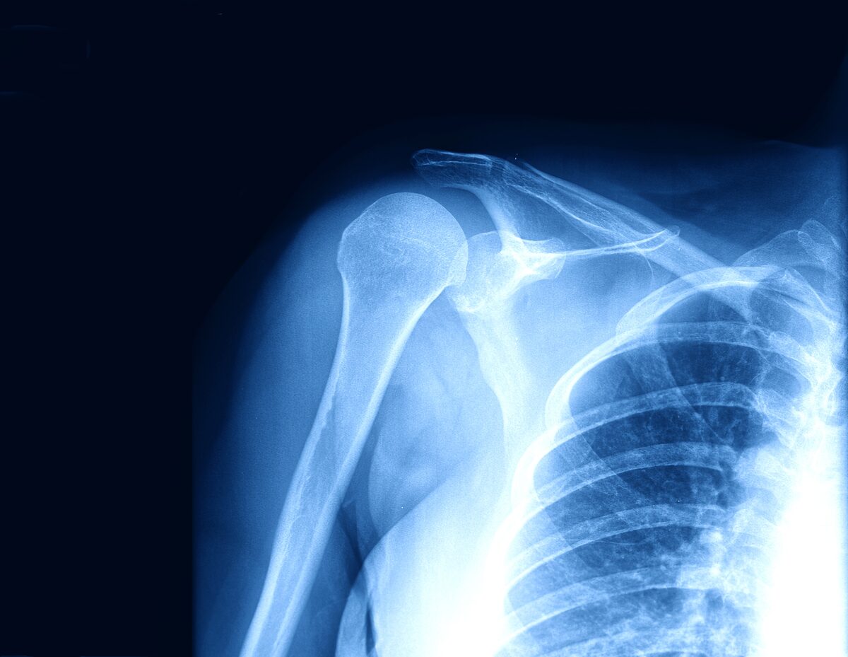 Digital X-ray imaging at Integrated Imaging Houston for bone, chest, and diagnostic radiography